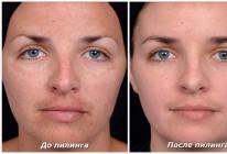 Пилинг лица — косметологическая процедура